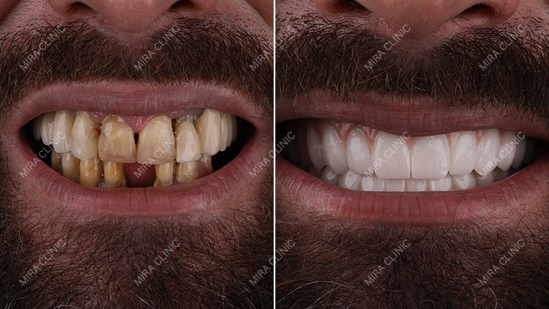 E-max Before and After